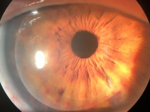 corneal transplant