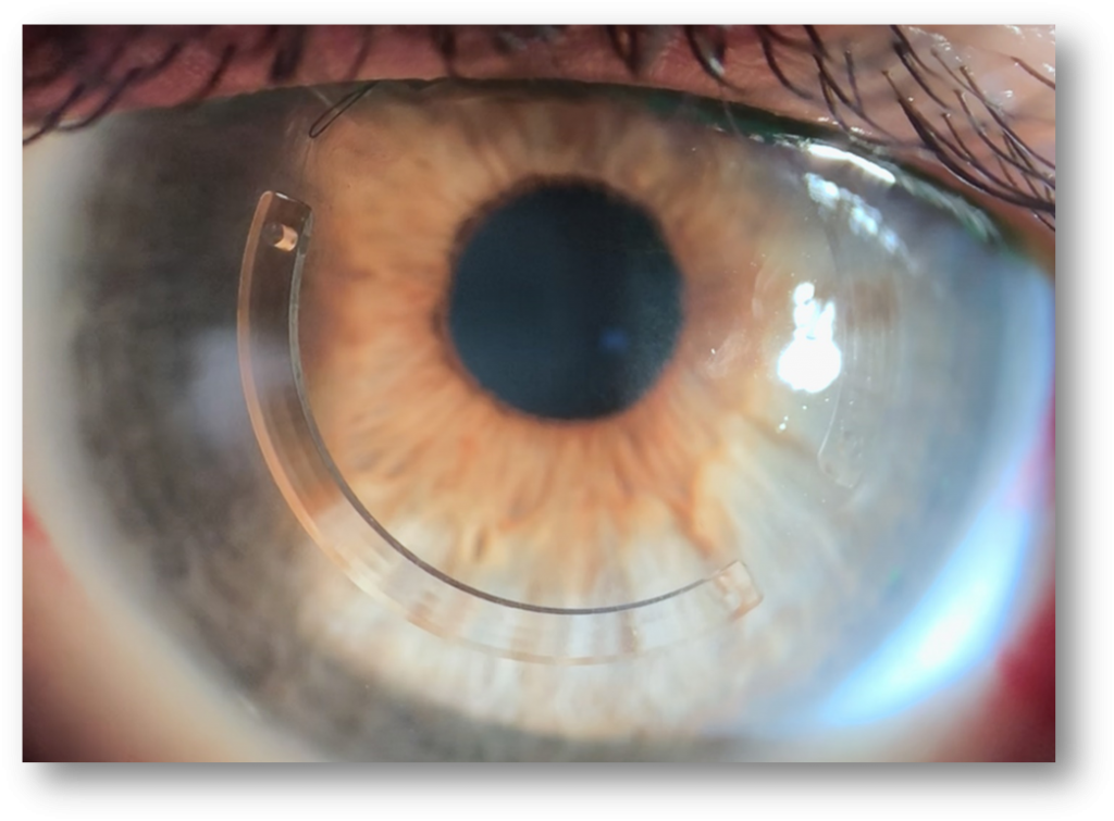 keratoconus corneal transplant